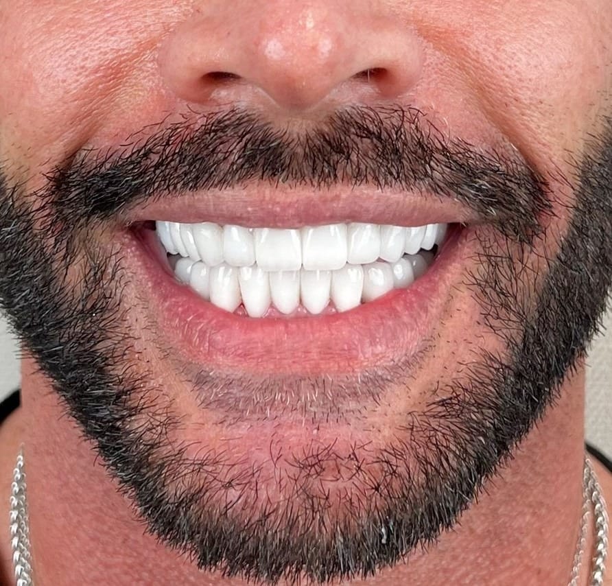 Hollywood Smile after treatment at Seta Clinic Global, shared with patient consent