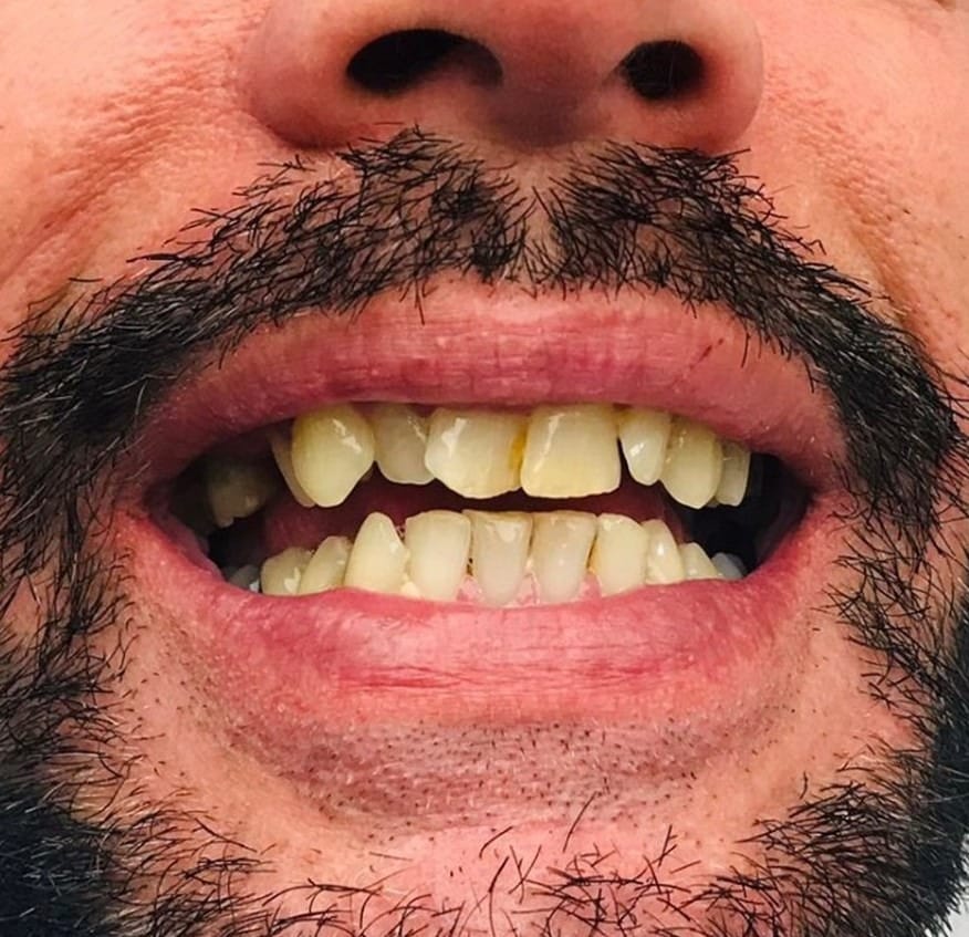 Hollywood Smile before treatment at Seta Clinic Global, shared with patient consent