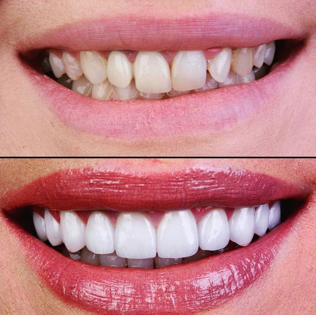 Hollywood Smile, before and after