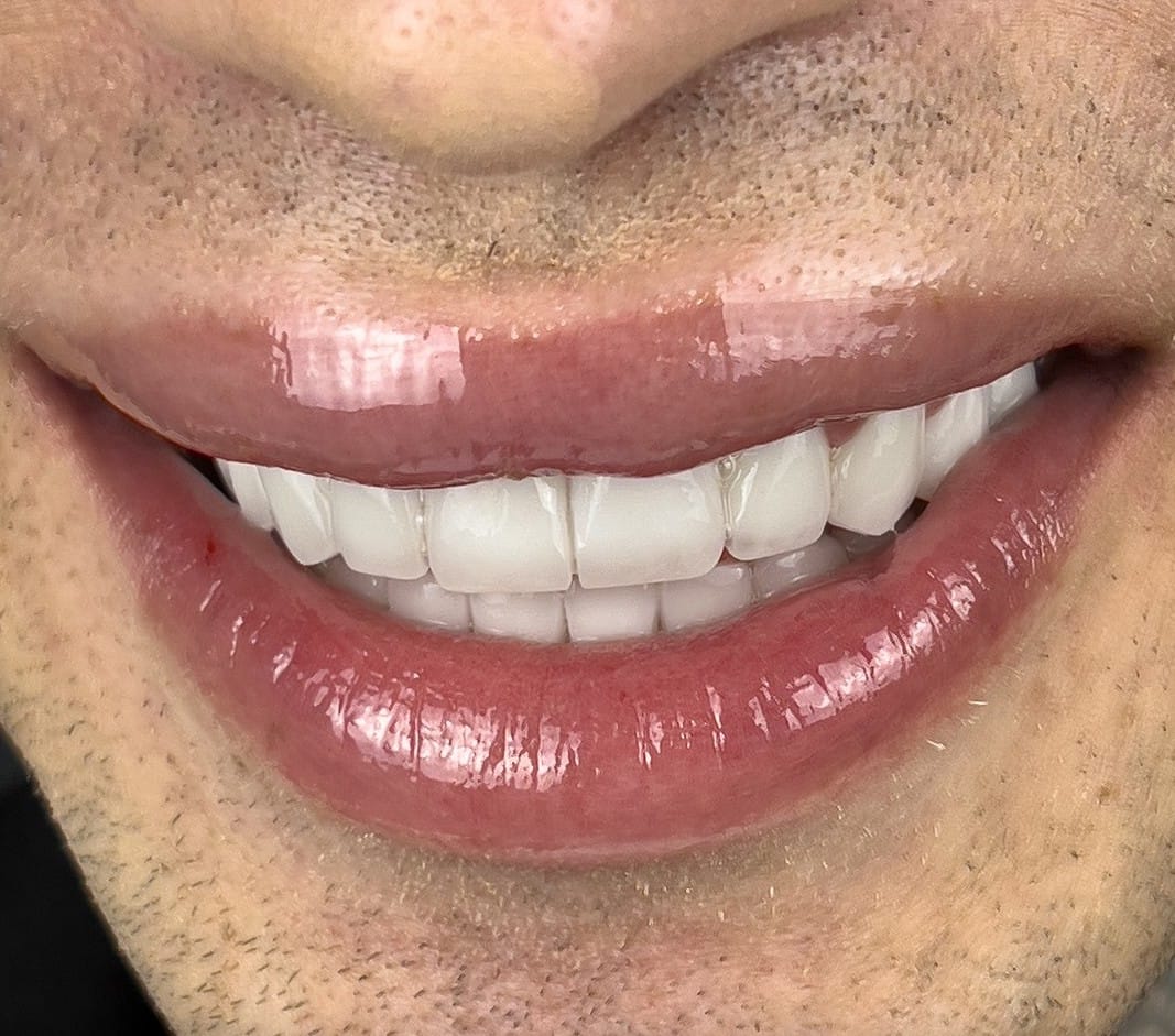 Hollywood Smile after treatment at Seta Clinic Global, shared with patient consent