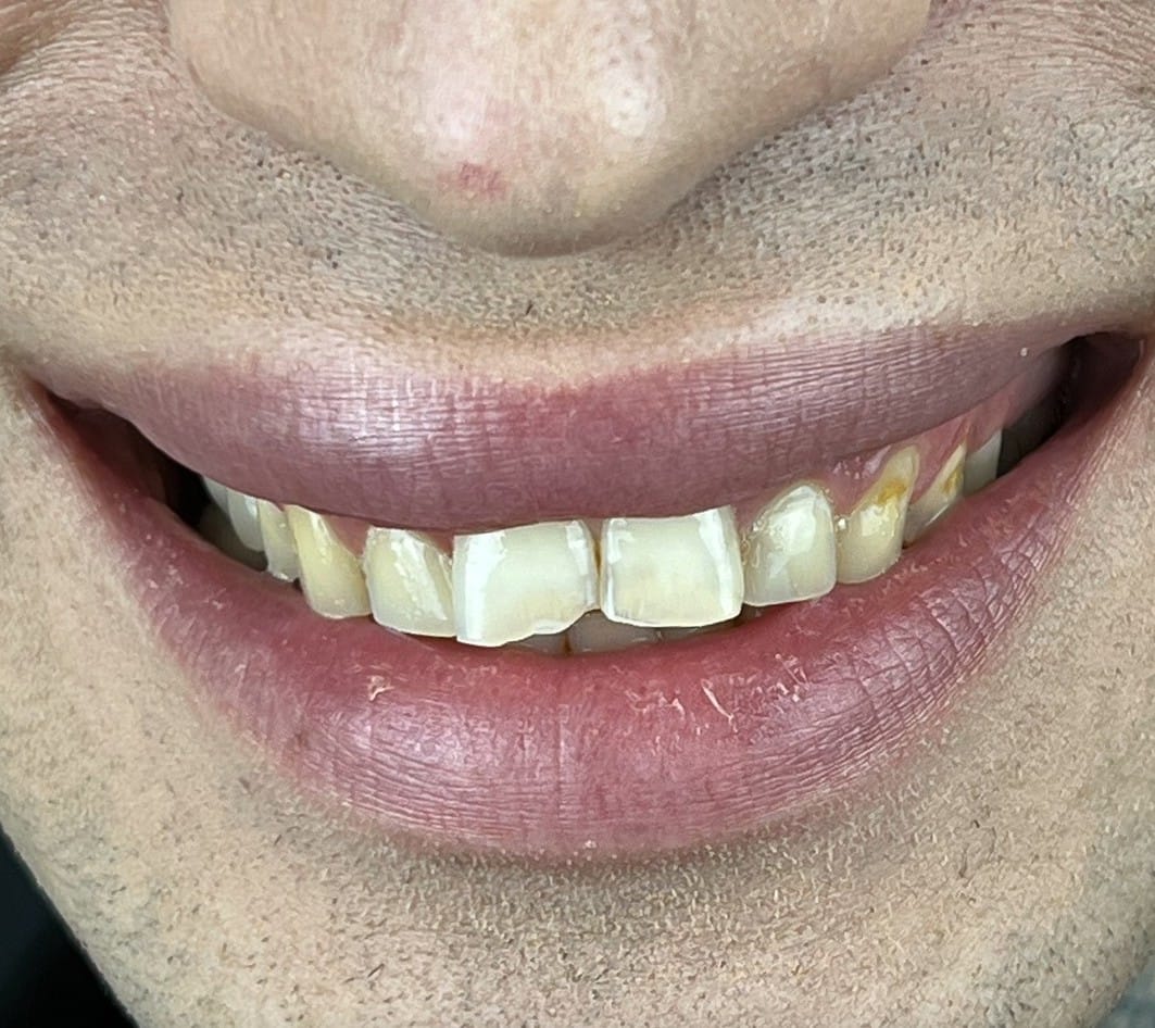 Hollywood Smile before treatment at Seta Clinic Global, shared with patient consent