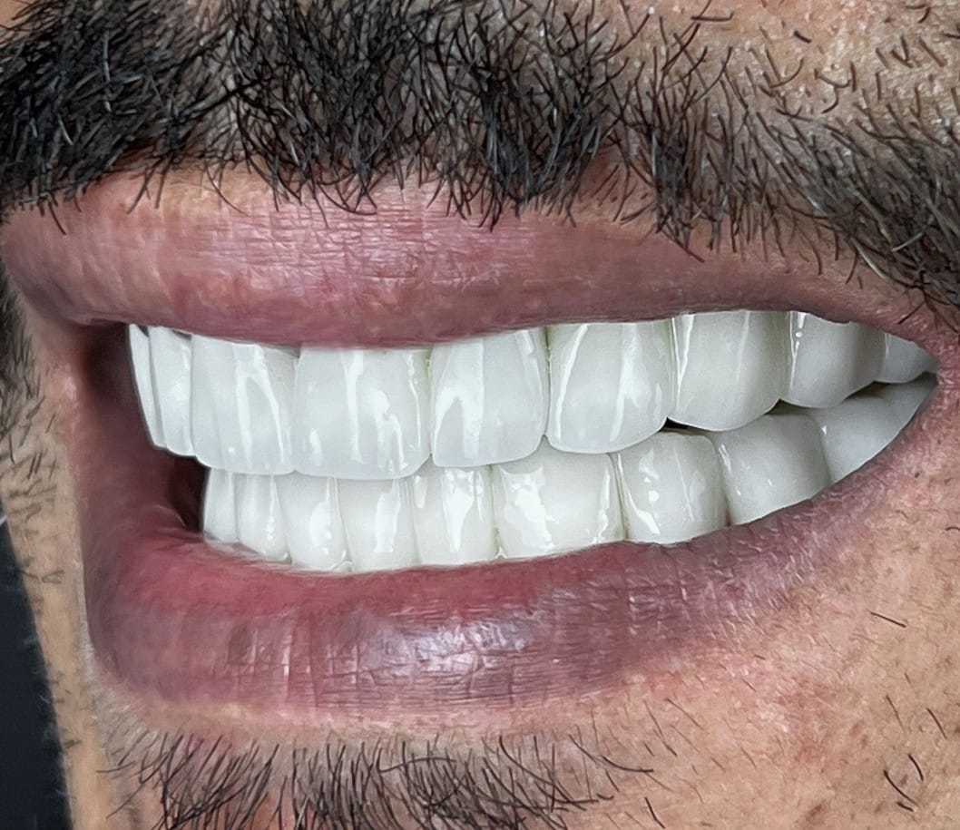 Hollywood Smile after treatment at Seta Clinic Global, shared with patient consent