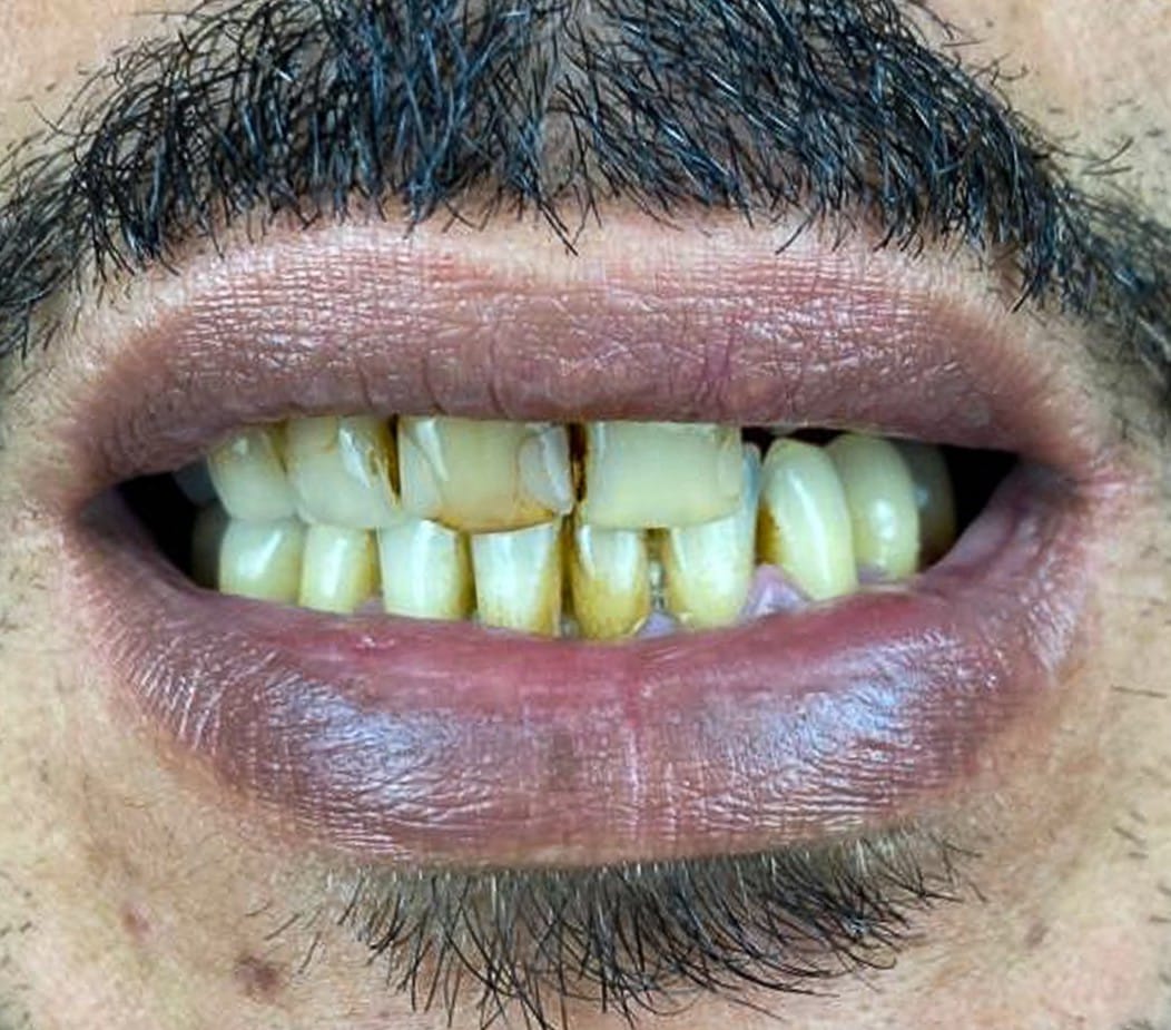 Hollywood Smile before treatment at Seta Clinic Global, shared with patient consent