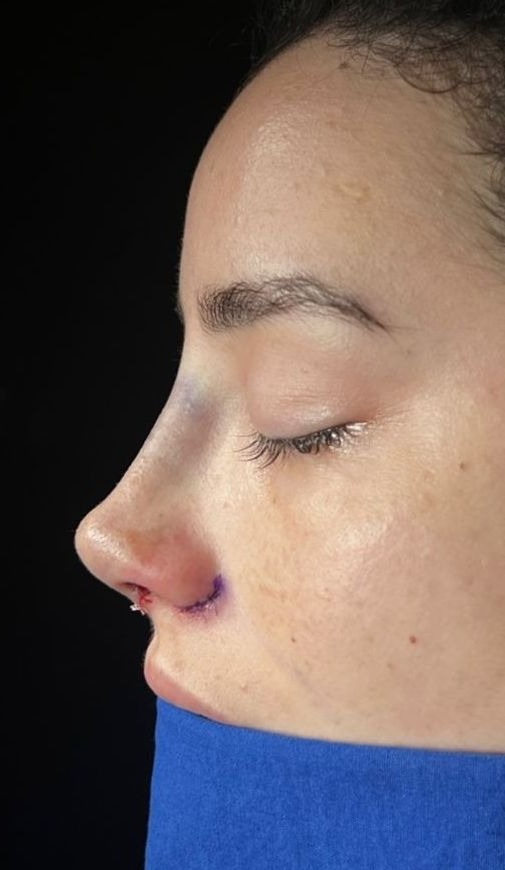 Rhinoplasty after treatment at Seta Clinic Global, shared with patient consent