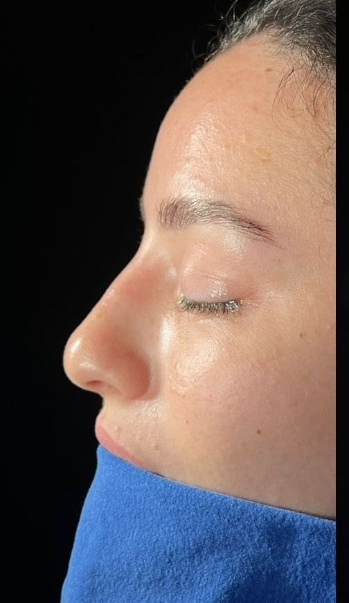 Rhinoplasty before treatment at Seta Clinic Global, shared with patient consent