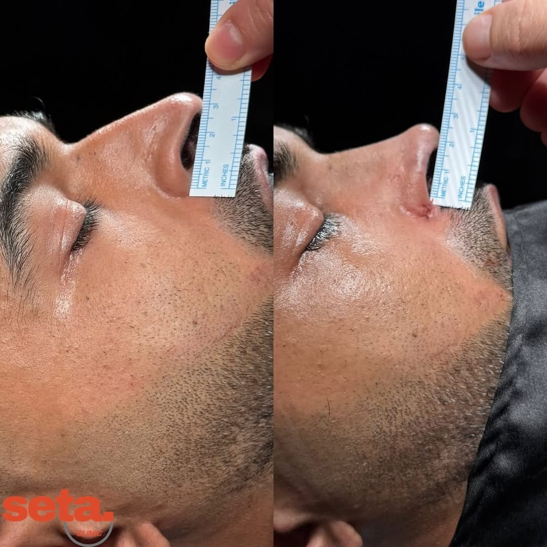Rhinoplasty, before and after