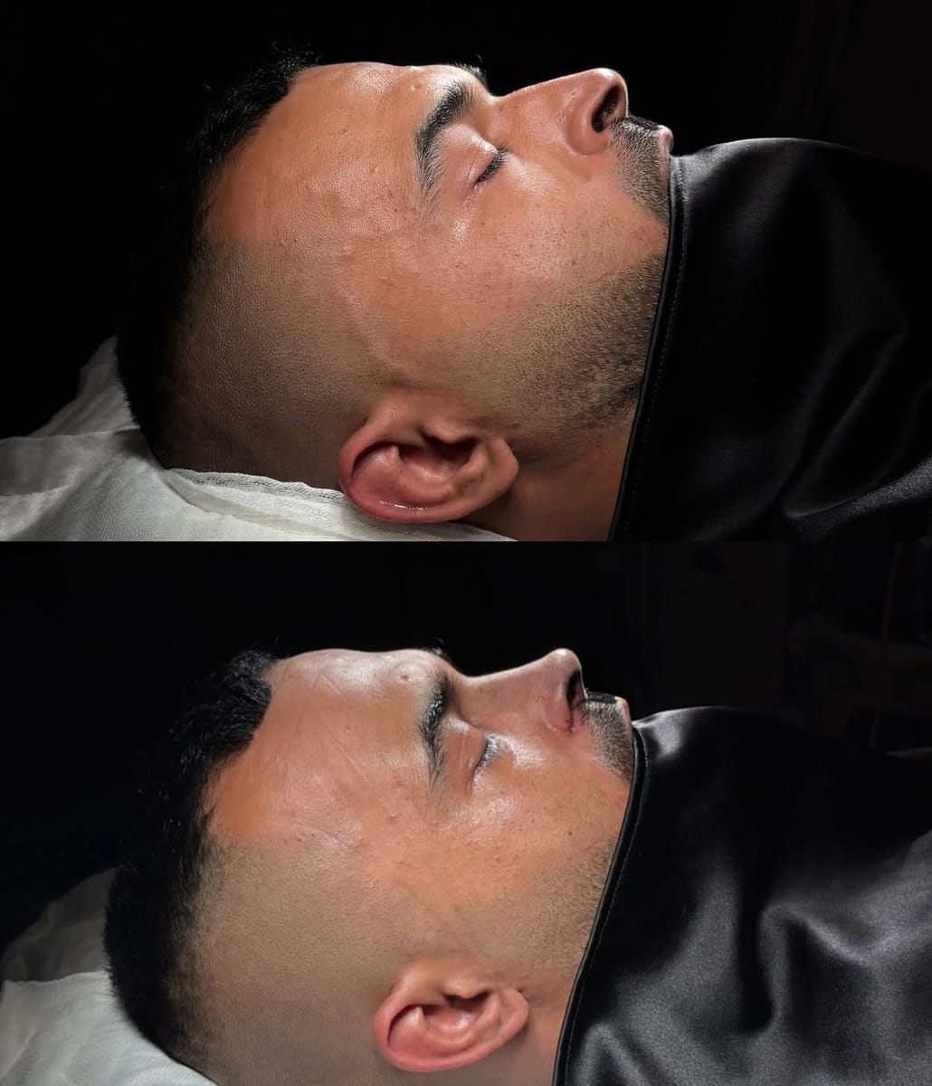 Rhinoplasty, before and after