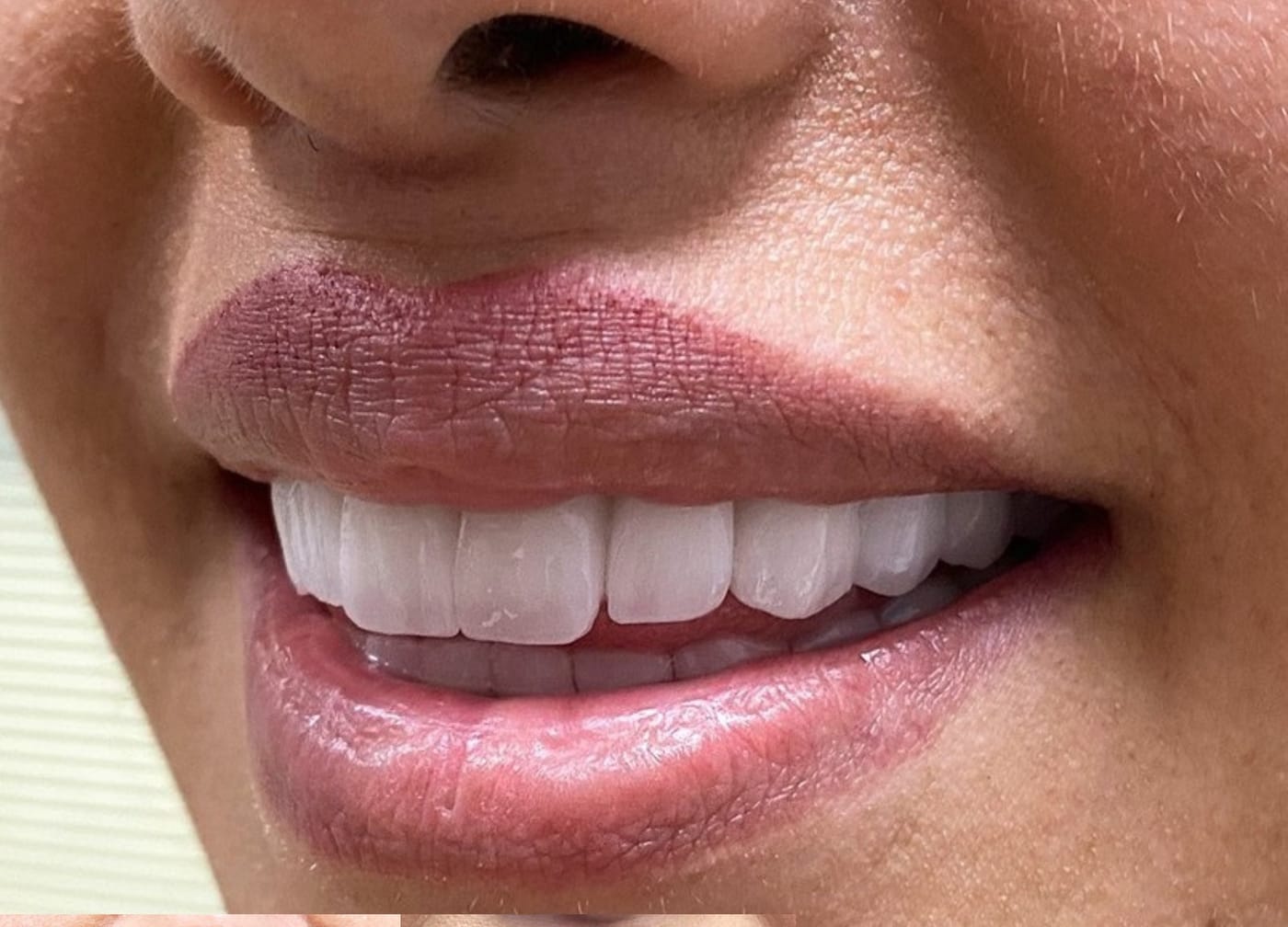 Dental Aesthetics